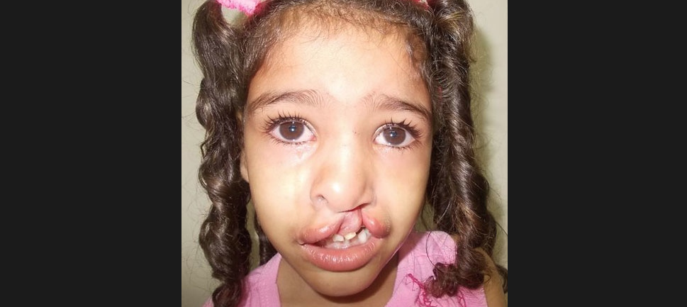 Bianca - Sample Cleft Palate